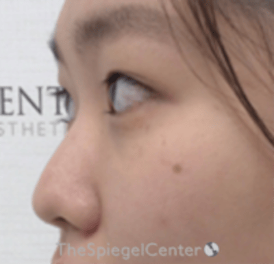 Non-Surgical Rhinoplasty Before & After Gallery - Patient 676344 - Image 3