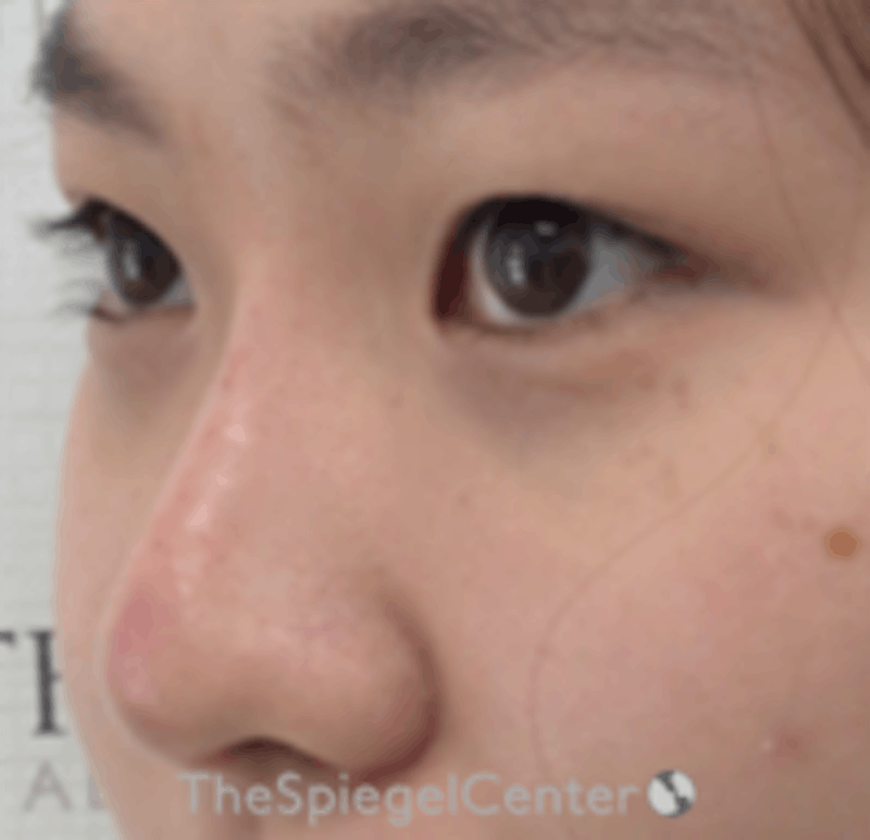 Non-Surgical Rhinoplasty / Nose Filler Before & After Gallery - Patient 212825 - Image 4