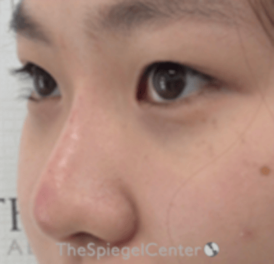 Non-Surgical Rhinoplasty Before & After Gallery - Patient 676344 - Image 4