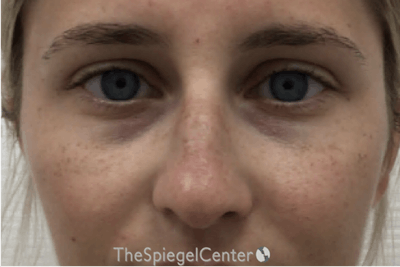 Non-Surgical Rhinoplasty / Nose Filler Before & After Gallery - Patient 190460 - Image 1
