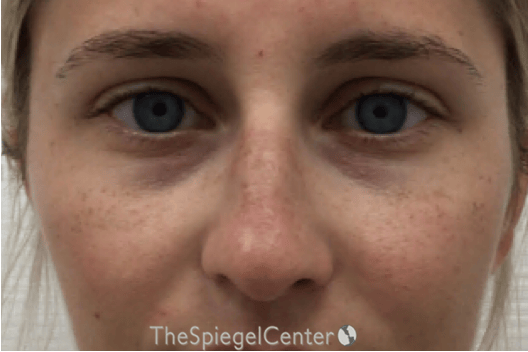 Non-Surgical Rhinoplasty / Nose Filler Before & After Gallery - Patient 190460 - Image 1