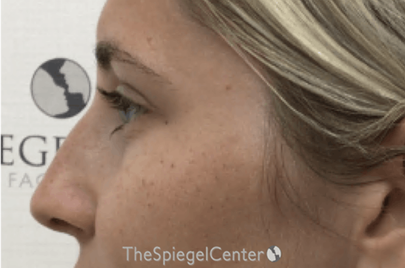 Non-Surgical Rhinoplasty / Nose Filler Before & After Gallery - Patient 190460 - Image 3