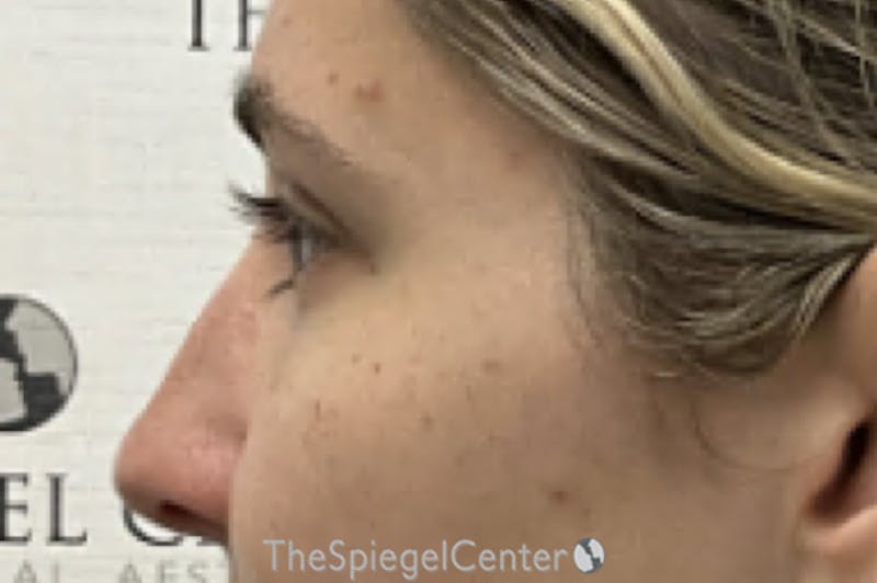 Non-Surgical Rhinoplasty / Nose Filler Before & After Gallery - Patient 190460 - Image 4