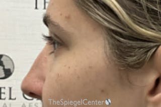 Non-Surgical Rhinoplasty / Nose Filler Before & After Gallery - Patient 190460 - Image 4