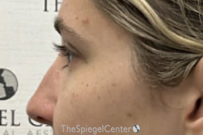 Non-Surgical Rhinoplasty / Nose Filler Before & After Gallery - Patient 190460 - Image 4
