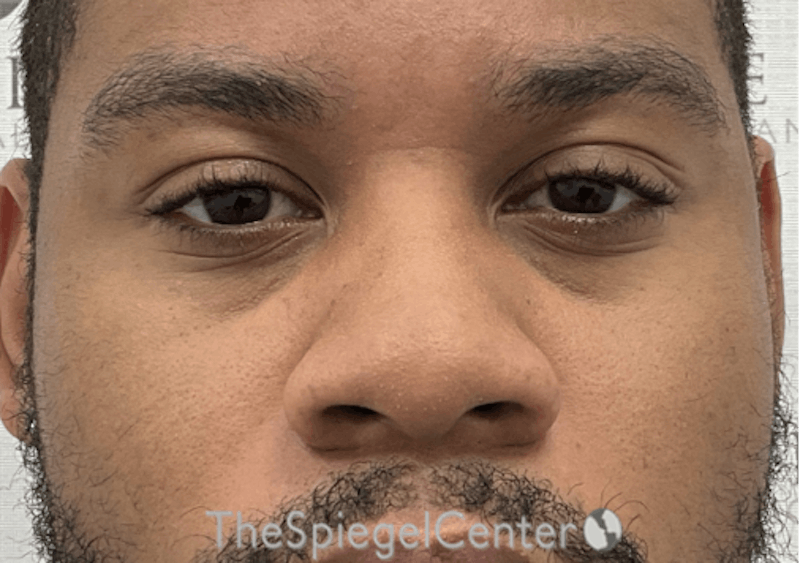 Non-Surgical Rhinoplasty / Nose Filler Before & After Gallery - Patient 219335 - Image 1