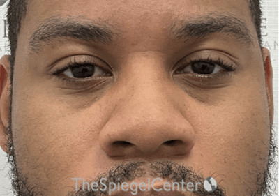 Non-Surgical Rhinoplasty / Nose Filler Before & After Gallery - Patient 219335 - Image 1