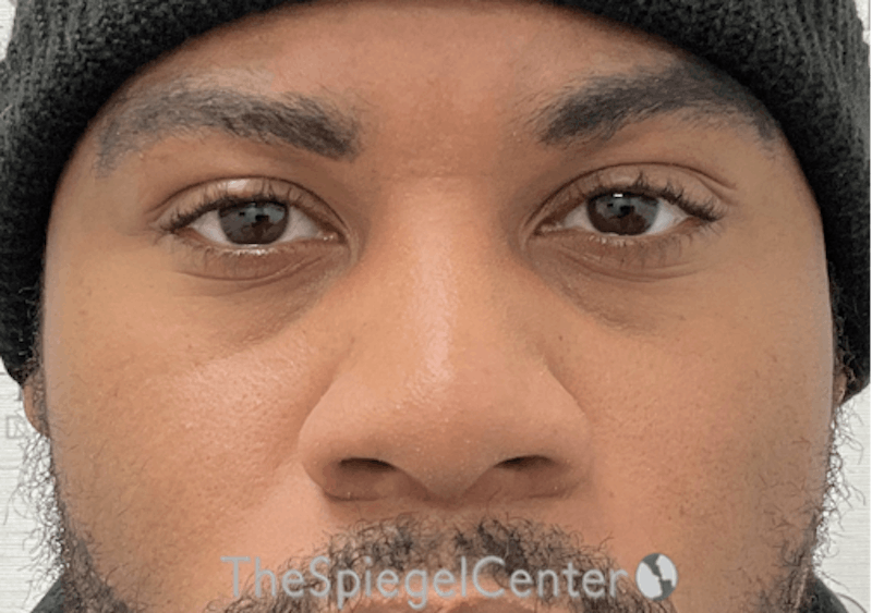 Non-Surgical Rhinoplasty / Nose Filler Before & After Gallery - Patient 219335 - Image 2