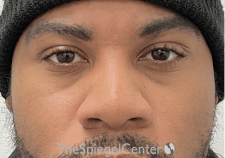 Non-Surgical Rhinoplasty / Nose Filler Before & After Gallery - Patient 219335 - Image 2