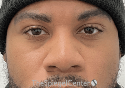 Non-Surgical Rhinoplasty / Nose Filler Before & After Gallery - Patient 219335 - Image 2
