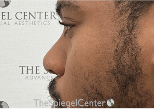 Non-Surgical Rhinoplasty / Nose Filler Before & After Gallery - Patient 219335 - Image 3