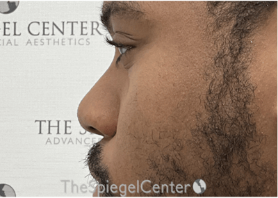 Non-Surgical Rhinoplasty / Nose Filler Before & After Gallery - Patient 219335 - Image 3