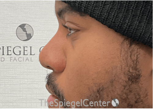 Non-Surgical Rhinoplasty / Nose Filler Before & After Gallery - Patient 219335 - Image 4