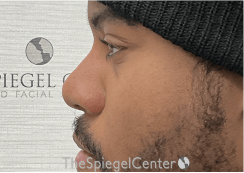 Non-Surgical Rhinoplasty / Nose Filler Before & After Gallery - Patient 219335 - Image 4