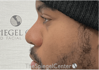 Non-Surgical Rhinoplasty / Nose Filler Before & After Gallery - Patient 219335 - Image 4