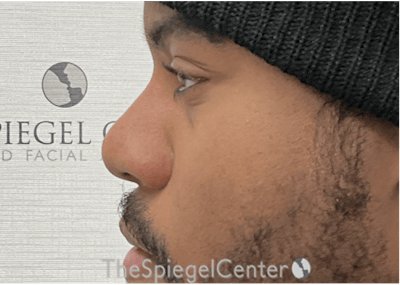 Non-Surgical Rhinoplasty / Nose Filler Before & After Gallery - Patient 219335 - Image 4