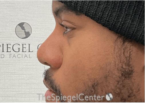 Non-Surgical Rhinoplasty / Nose Filler Before & After Gallery - Patient 219335 - Image 4