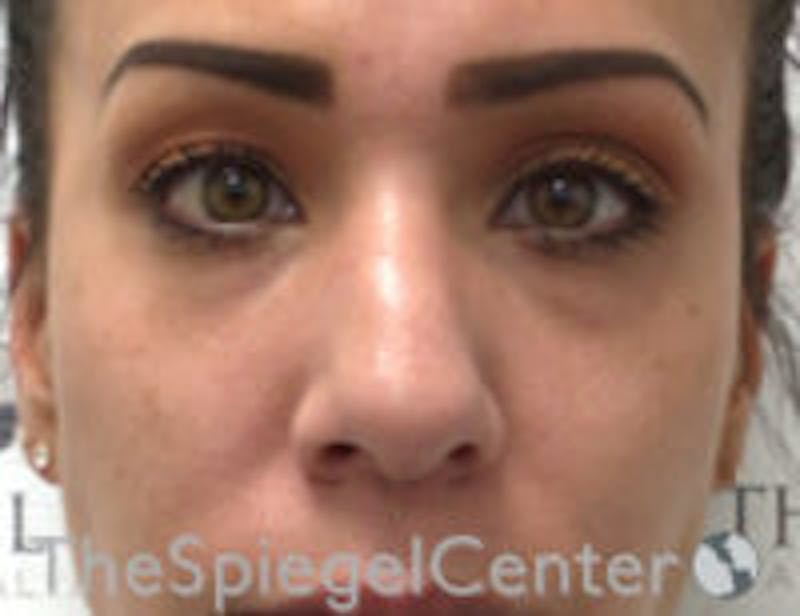 Non-Surgical Rhinoplasty / Nose Filler Before & After Gallery - Patient 199112 - Image 1