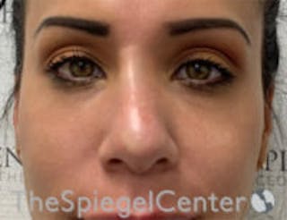 Non-Surgical Rhinoplasty / Nose Filler Before & After Gallery - Patient 199112 - Image 2