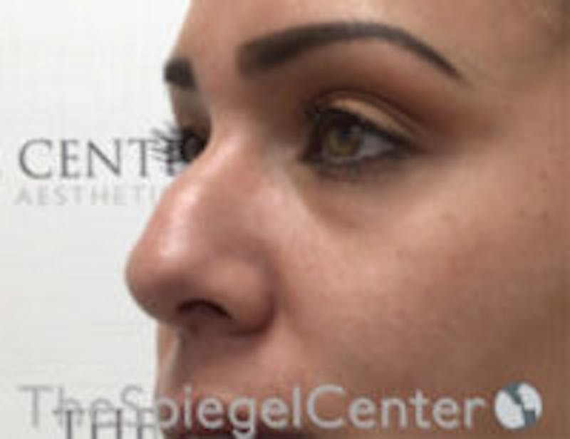 Non-Surgical Rhinoplasty / Nose Filler Before & After Gallery - Patient 199112 - Image 3