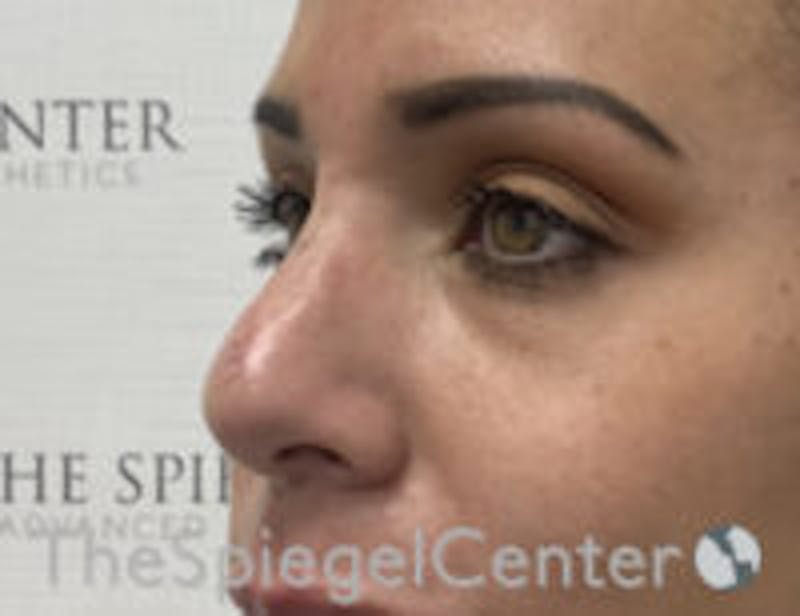 Non-Surgical Rhinoplasty / Nose Filler Before & After Gallery - Patient 199112 - Image 4