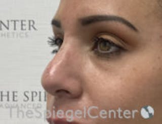 Non-Surgical Rhinoplasty / Nose Filler Before & After Gallery - Patient 199112 - Image 4