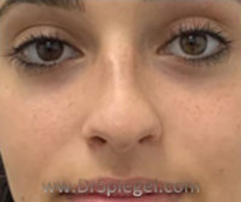 Non-Surgical Rhinoplasty / Nose Filler Before & After Gallery - Patient 250989 - Image 1