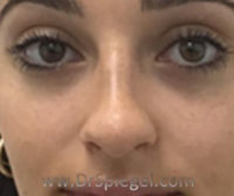 Non-Surgical Rhinoplasty / Nose Filler Before & After Gallery - Patient 250989 - Image 2