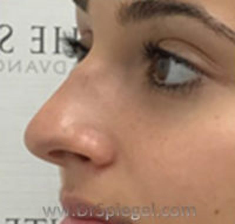 Non-Surgical Rhinoplasty / Nose Filler Before & After Gallery - Patient 250989 - Image 3