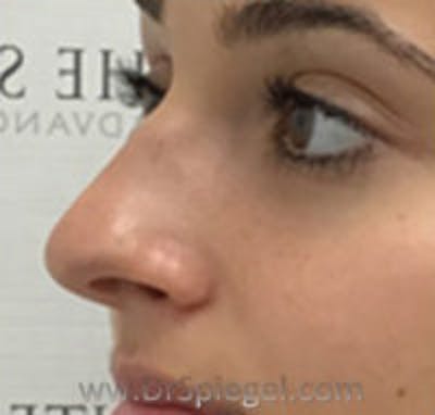 Non-Surgical Rhinoplasty / Nose Filler Before & After Gallery - Patient 250989 - Image 3