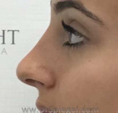Non-Surgical Rhinoplasty / Nose Filler Before & After Gallery - Patient 250989 - Image 4