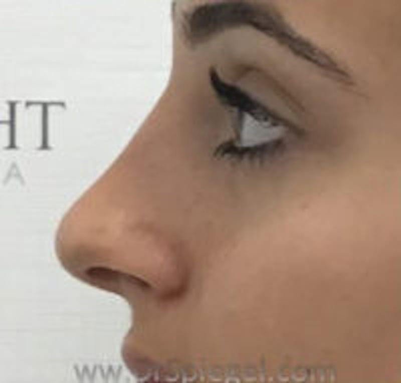 Non-Surgical Rhinoplasty / Nose Filler Before & After Gallery - Patient 250989 - Image 4