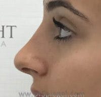 Non-Surgical Rhinoplasty / Nose Filler Before & After Gallery - Patient 250989 - Image 4