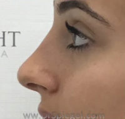 Non-Surgical Rhinoplasty / Nose Filler Before & After Gallery - Patient 250989 - Image 4