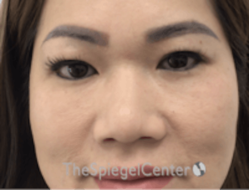 Non-Surgical Rhinoplasty / Nose Filler Before & After Gallery - Patient 133543 - Image 1