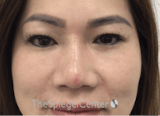 Non-Surgical Rhinoplasty / Nose Filler Before & After Gallery - Patient 133543 - Image 2