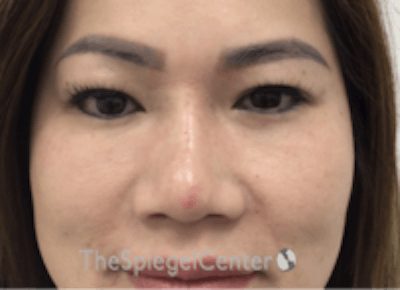 Non-Surgical Rhinoplasty / Nose Filler Before & After Gallery - Patient 133543 - Image 2