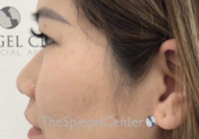 Non-Surgical Rhinoplasty / Nose Filler Before & After Gallery - Patient 133543 - Image 3