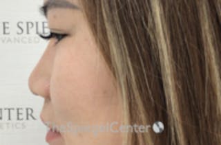 Non-Surgical Rhinoplasty / Nose Filler Before & After Gallery - Patient 133543 - Image 4