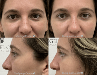 Non-Surgical Rhinoplasty / Nose Filler Before & After Gallery - Patient 360394 - Image 1