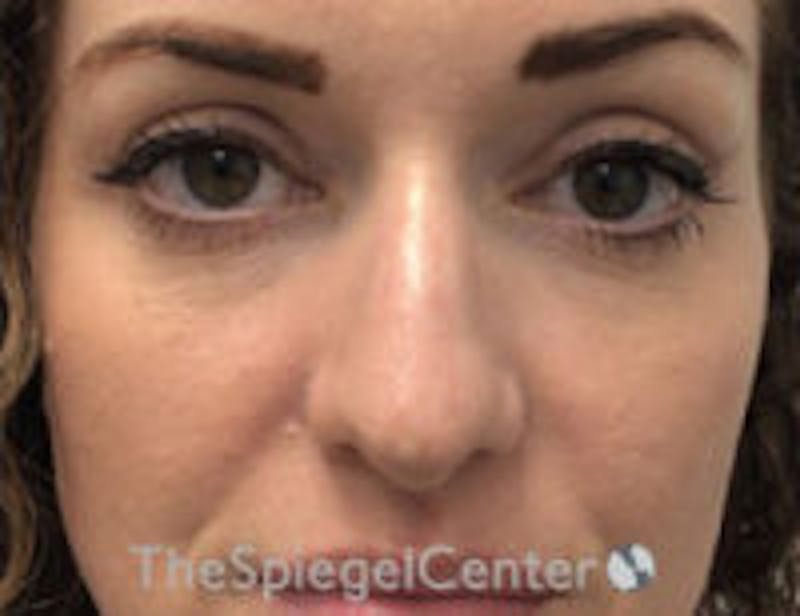 Non-Surgical Rhinoplasty / Nose Filler Before & After Gallery - Patient 328220 - Image 1