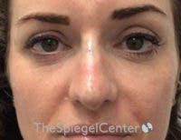 Non-Surgical Rhinoplasty / Nose Filler Before & After Gallery - Patient 328220 - Image 2
