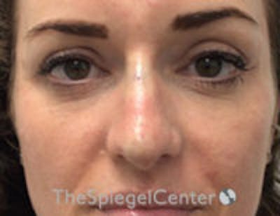 Non-Surgical Rhinoplasty / Nose Filler Before & After Gallery - Patient 328220 - Image 2