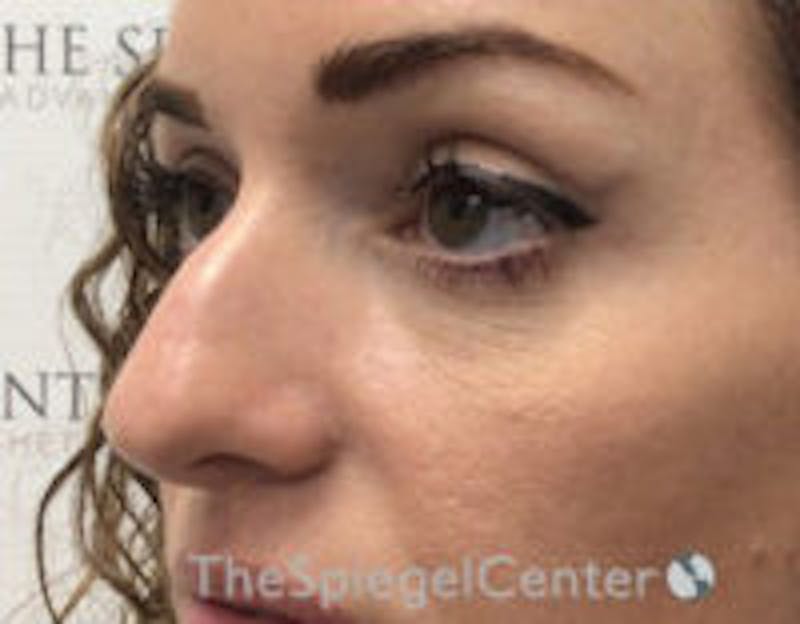 Non-Surgical Rhinoplasty / Nose Filler Before & After Gallery - Patient 328220 - Image 3
