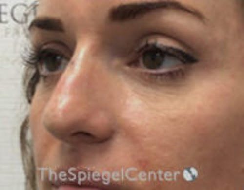 Non-Surgical Rhinoplasty / Nose Filler Before & After Gallery - Patient 328220 - Image 4