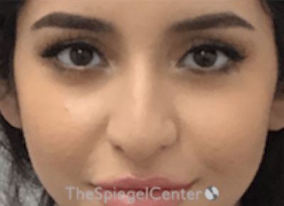 Non-Surgical Rhinoplasty / Nose Filler Before & After Gallery - Patient 167327 - Image 1