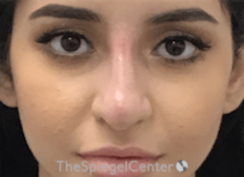 Non-Surgical Rhinoplasty / Nose Filler Before & After Gallery - Patient 167327 - Image 2