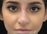 Non-Surgical Rhinoplasty / Nose Filler Before & After Gallery - Patient 167327 - Image 2