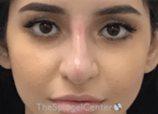 Non-Surgical Rhinoplasty / Nose Filler Before & After Gallery - Patient 167327 - Image 2