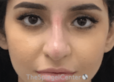 Non-Surgical Rhinoplasty / Nose Filler Before & After Gallery - Patient 167327 - Image 2